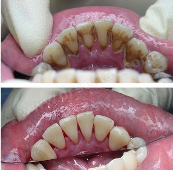 diş taşı temizliği ile diş beyazlatma